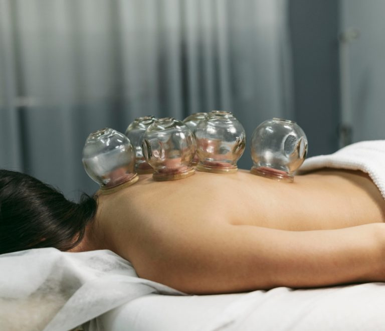 Cupping Therapy